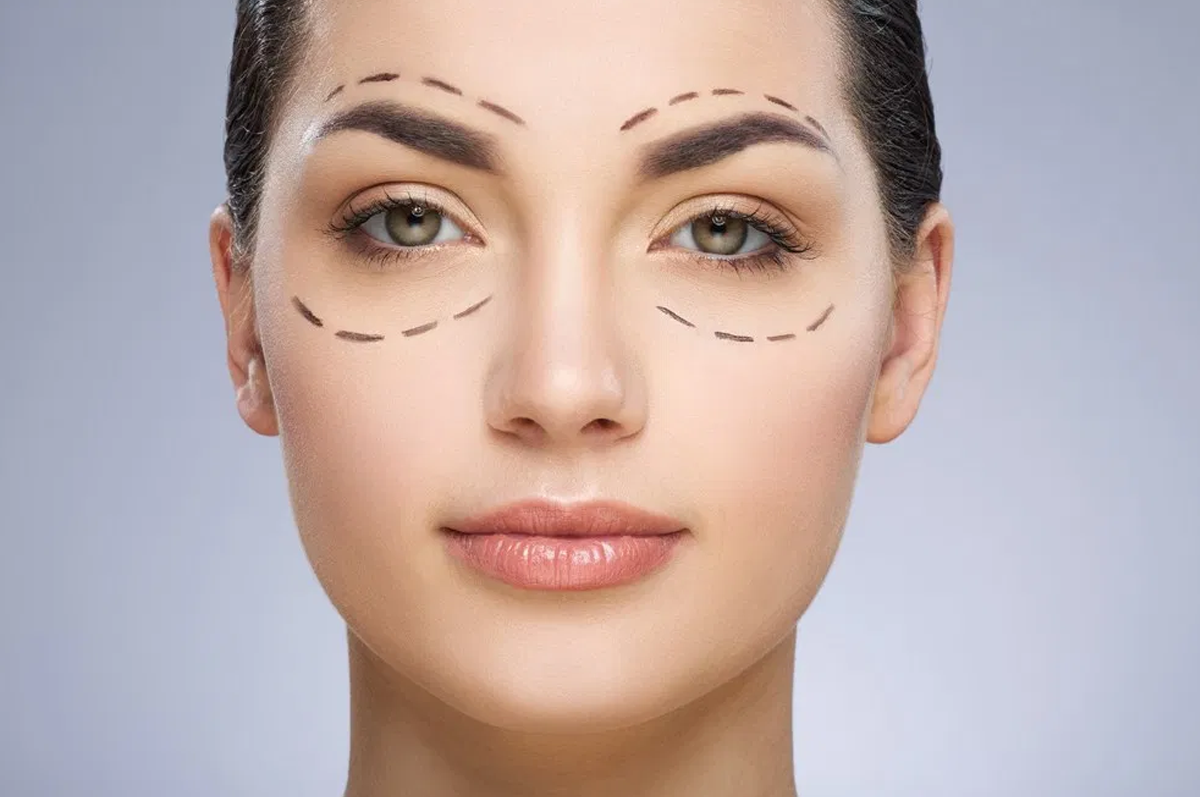 Blefaroplastia-2